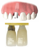 step2 �A�o�b�g�����g